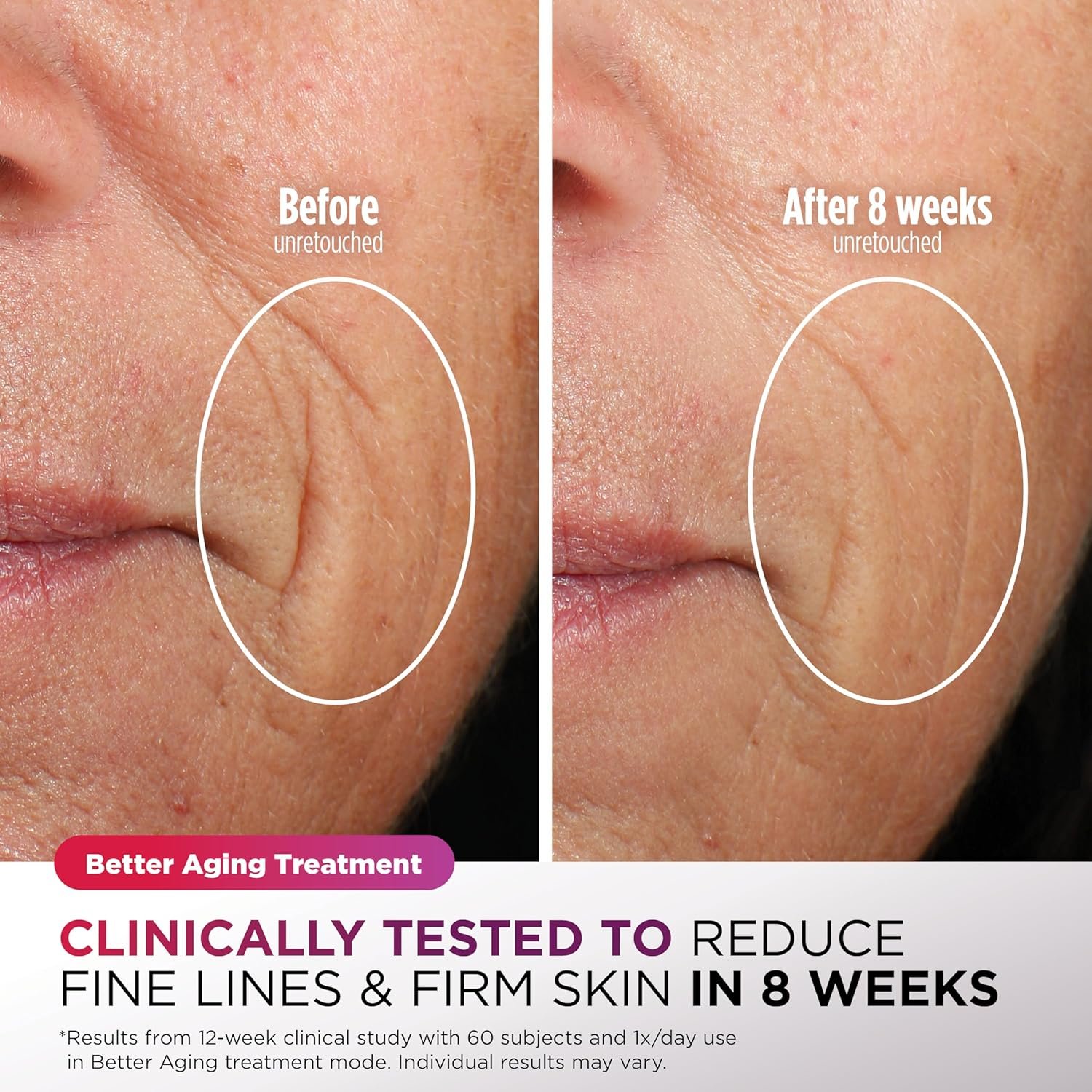 Shark CryoGlow brand before and after fine-line image