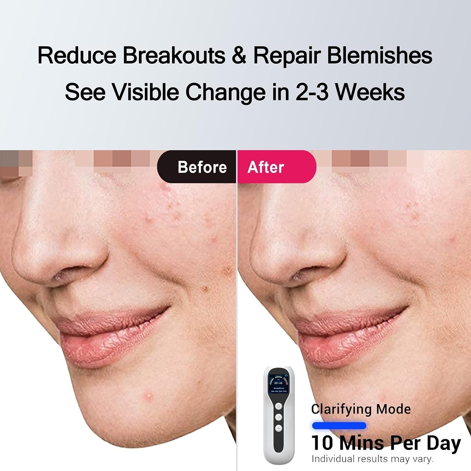 Zeepeak 3D LED Face Mask blemish repair mode