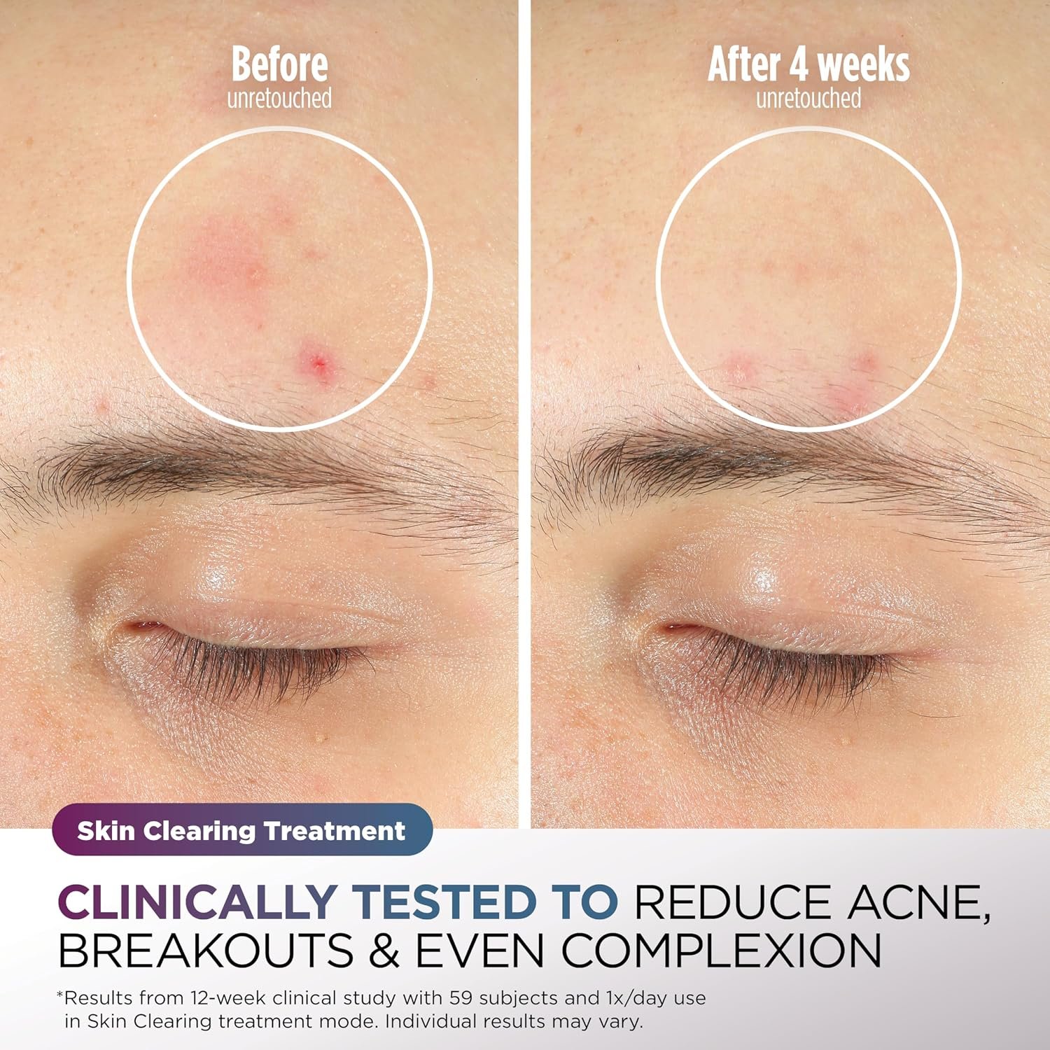 Shark CryoGlow brand before and after blemish image
